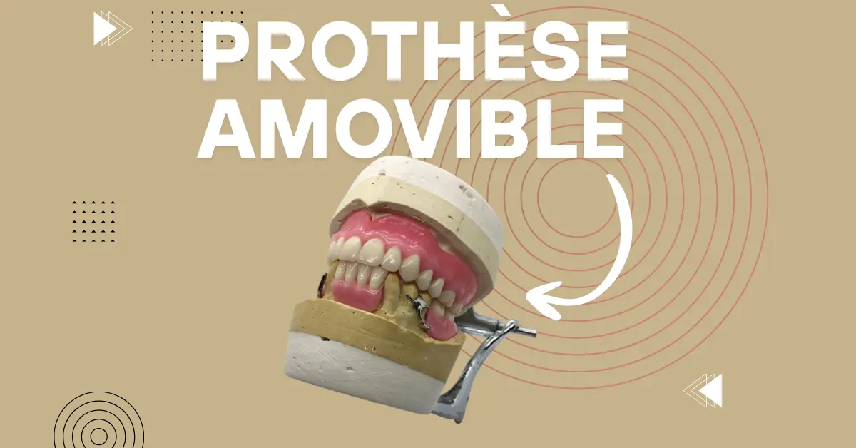 Prothèse dentaire amovible - Laboratoire Dentaire Marrakech