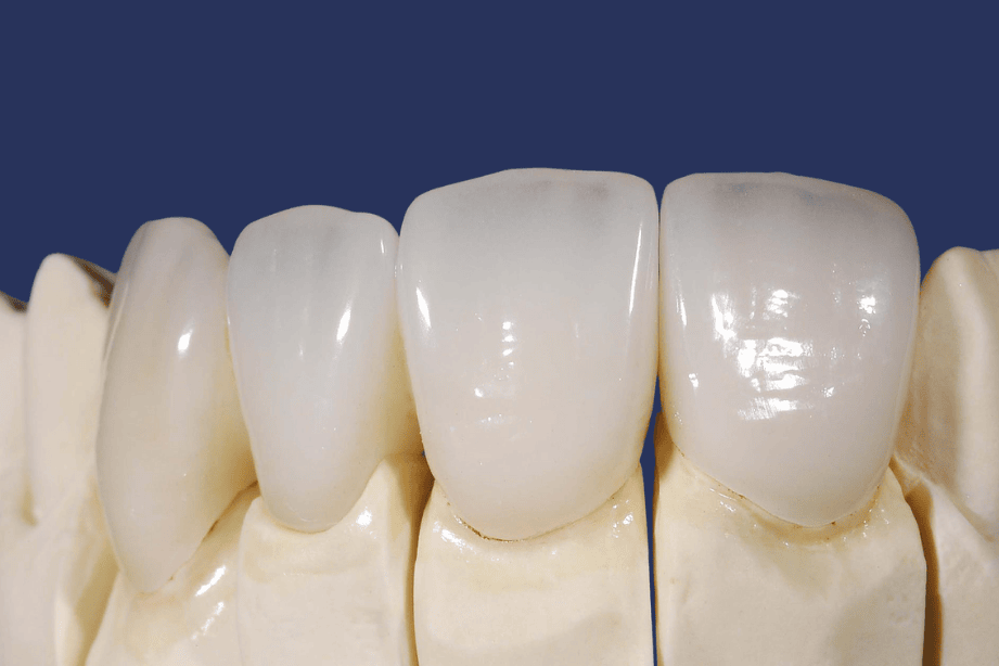 Facette E-max